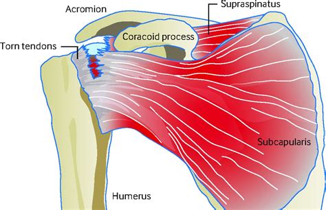 Supraspinatus Muscle Tear