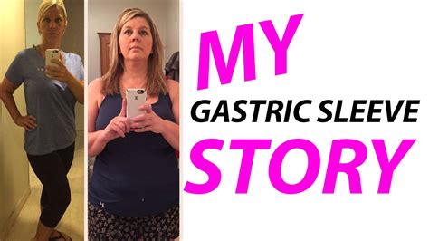 Gastric Sleeve Surgery Success Stories with Before & After Photos