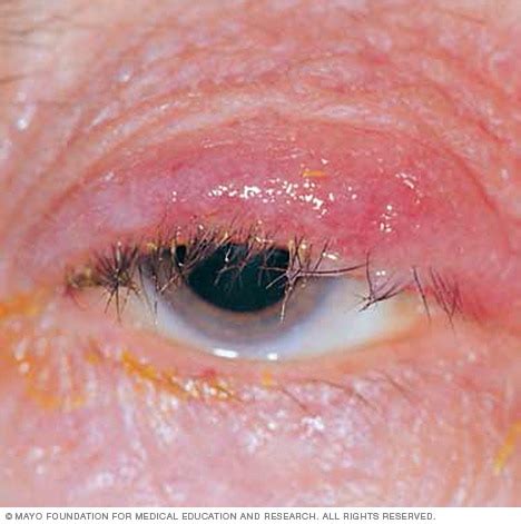 Blepharitis - Symptoms & causes - Mayo Clinic