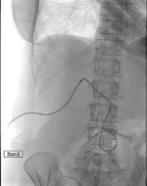 e Placement of an internal-external biliary drain. | Download ...