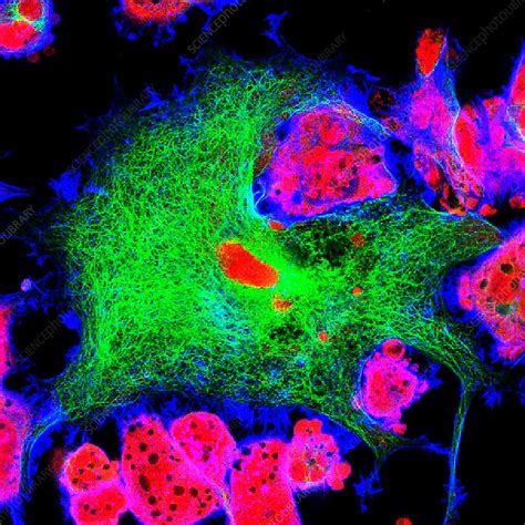 Neuroblastoma cells, fluorescence light micrograph - Stock Image - C034 ...