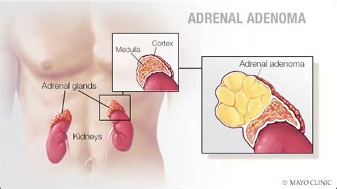 Mayo Clinic Q and A: Understanding adrenal adenoma - Mayo Clinic News ...