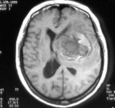 Cerebral Aneurysm Angiogram