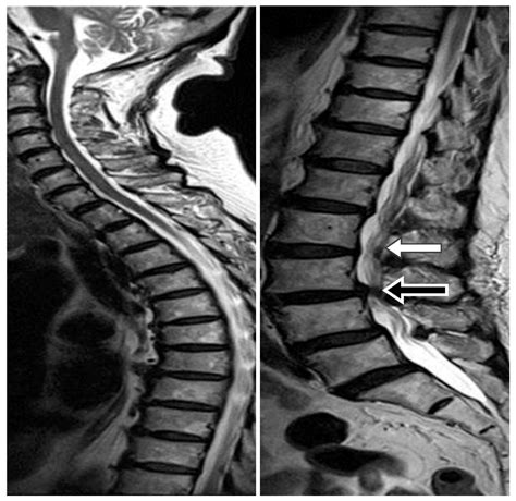 Medicina | Free Full-Text | Lumboperitoneal Shunt: A New Modified ...