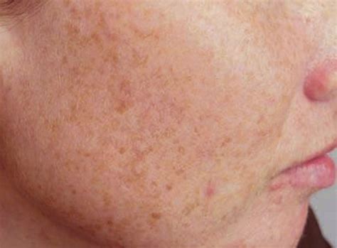 Liver Spots: Causes, Treatments, and Removal Options | YouMeMindBody