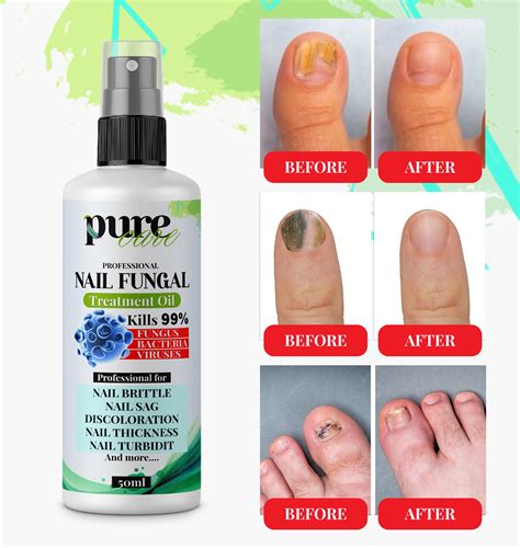 Anti Fungal Treatment Fungus Effective Toe Nail Repair Solution UK 50ml ...