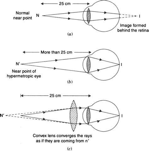 NEET UG : Hypermetropia