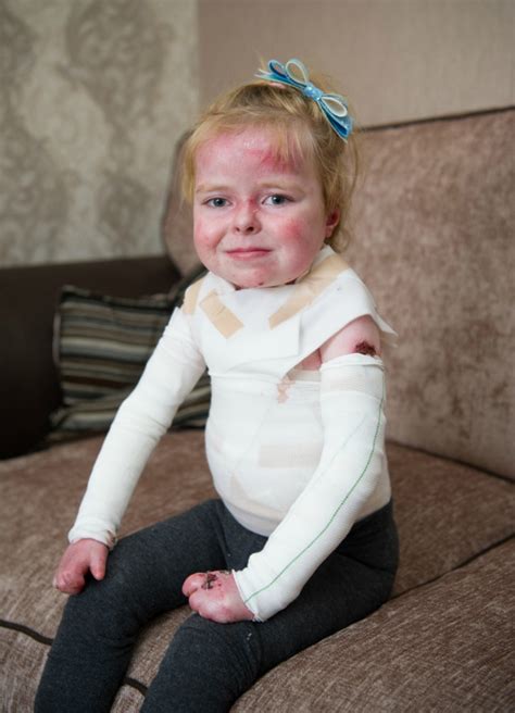 Five-Year-Old Launches Campaign For People With Butterfly Skin Disease