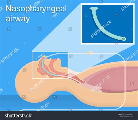 10 Oropharyngeal airway insertion bilder, arkivfotografier og vektorer ...