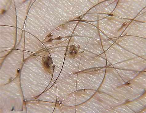 Pubic lice or crab lice signs, symptoms, transmission & pubic lice ...