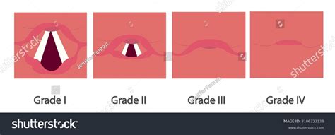 Cormacklehane System Assess Airway Dificulty Intubation Stock ...