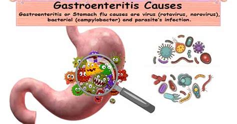 Gastroenteritis Causes Stomach Flu | Virus, Bacterial Gastroenteritis