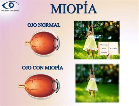 miopia - Oftalmologia Obispado Monterrey