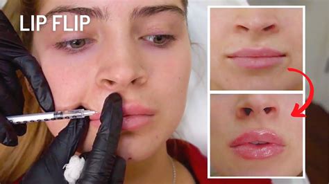 Lip Flip Botox Before And After Photos - Infoupdate.org