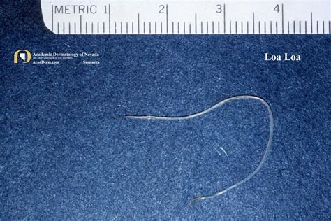 Loiasis: Loa Loa, Tropical Swelling... - Academic Dermatology of Nevada