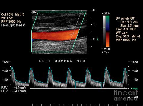 Carotid Duplex Ultrasound Exam Photograph by Living Art Enterprises ...