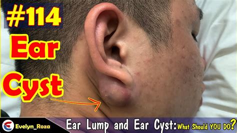 Removal Ear Lump and Ear Cyst | Acne Million views | Acne Treament #114 ...