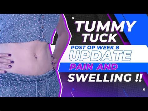 Swelling week by week tummy tuck recovery - mytece