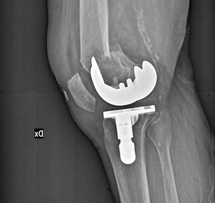 Total knee arthroplasty periprosthetic fracture - type II Lewis and ...