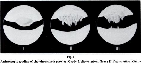 The Arthroscopic Treatment of Chondromalacia - Semantic Scholar