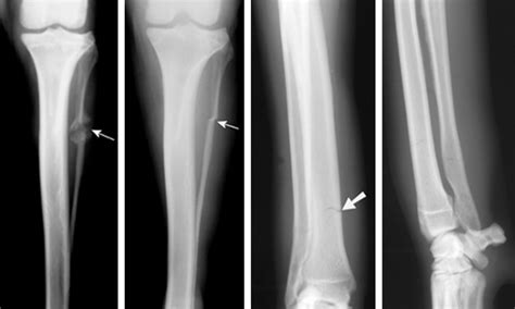 Hairline Bone Fracture