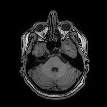 Pleomorphic xanthoastrocytoma | Image | Radiopaedia.org