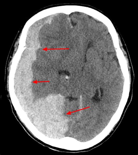 Tentorial Subdural Hematoma Subdural Hematoma What Causes Dementia ...