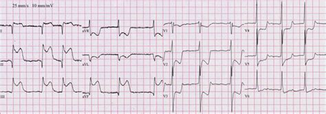 Inferior Stemi