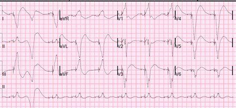 Dr. Smith's ECG Blog: Patient with Paced Rhythm in Severe ...