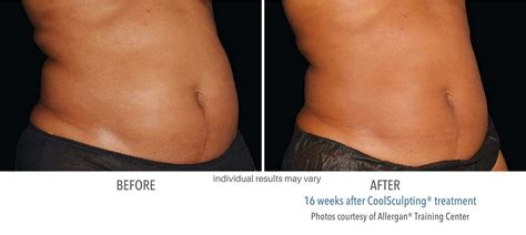 CoolSculpting before and after results from real patients - SCULPTDTLA.COM