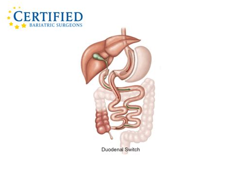 Duodenal Switch Surgery | Certified Bariatric Surgeons