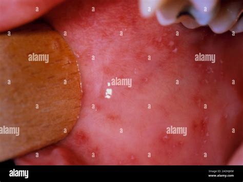 Koplik's spots in the mouth of a child suffering from measles. These ...