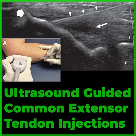 Ultrasound-Guided Lateral Epicondyle Injection - Sports Medicine Review