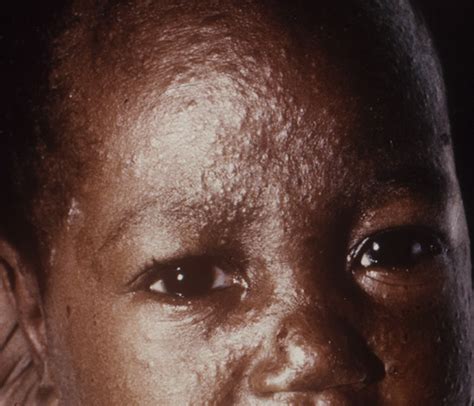 Measles- Causes, Symptoms, Treatment, Diagnosis and Prevention ...