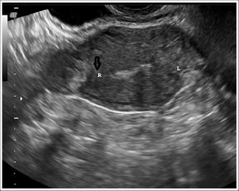 Coronal view of the fundus of the uterus on transvaginal ultrasound ...