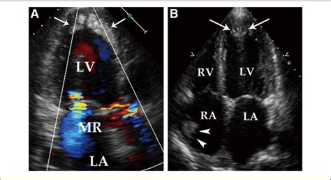 Preoperative transthoracic echocardiography (TTE). (A) TTE performed at ...