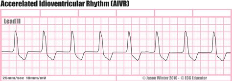 ECG Educator Blog : Accelerated Idioventricular Rhythm (AIVR)