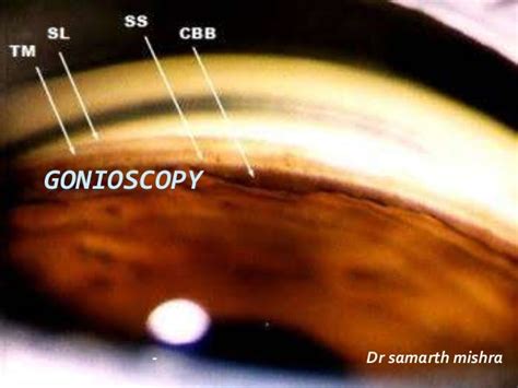 Gonioscopy: gonioscopic lenses, principle and clinical aspects