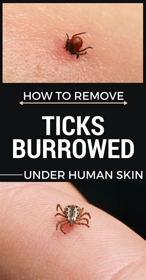 How To Remove Ticks Burrowed Under Human Skin? - BeautyHealther.org ...