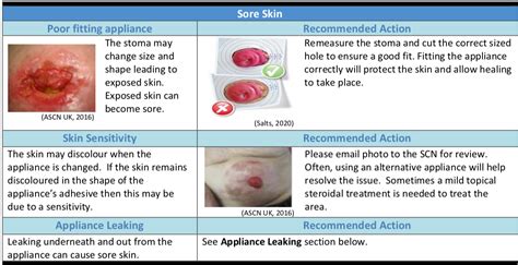 Colostomy Nursing Care