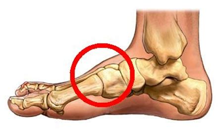 Midfoot (Tarsometatarsal) Fusion - Dr Greg Sterling