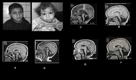 Pontocerebellar hypoplasia: Case13 & 14; male and female sibs: (A & B ...