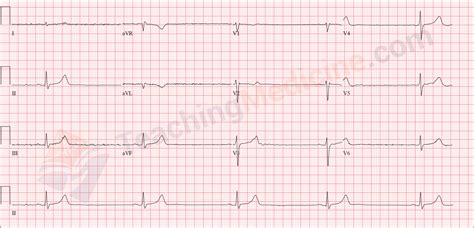 Teaching Medicine - Tutorial: Rhythm Diagnostic Criteria