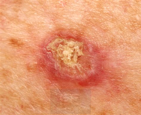 Skin Cancer and Precancerous Skin Lesions: What you need to know - Skin ...