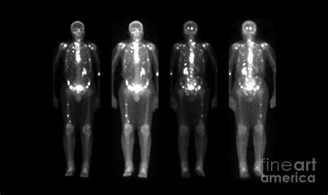 Nuclear Medicine Bone Scan Photograph by Medical Body Scans