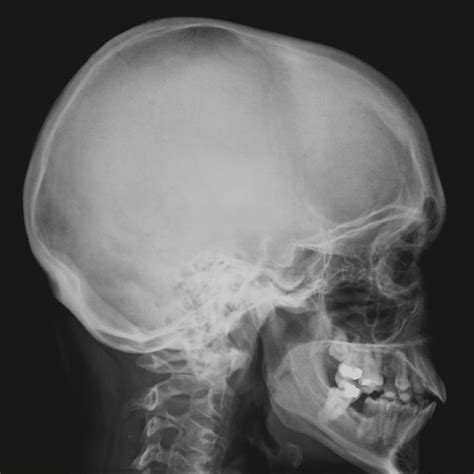 Human Skull Anatomy Lateral View