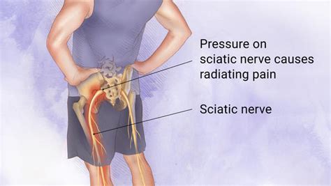 Sciatica and Trapped Sciatic Nerve | Heales Chiropractic Clinic