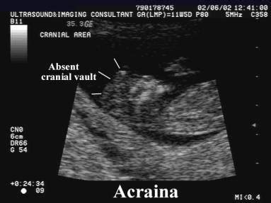 Anencephaly Ultrasound