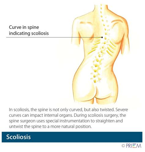 Scoliosis & Spinal Deformity Treatment in Reno and Carson City | Swift ...