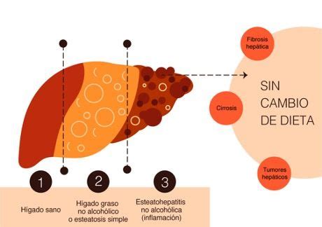 Dieta para el hígado graso | Centro Júlia Farré